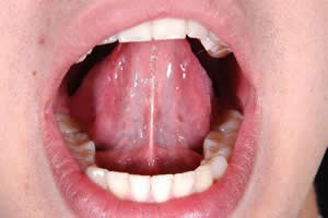 Covid-19 mostra sinais na boca, debaixo da língua, coluna Hewelyn Reis